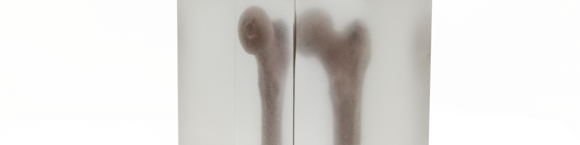 The anthropomorphic femur represents a proximal femur of a 55-year-old white female: water-equivalent material enriched with calcium hydroxyapatite and embedded in a tissue-equivalent matrix